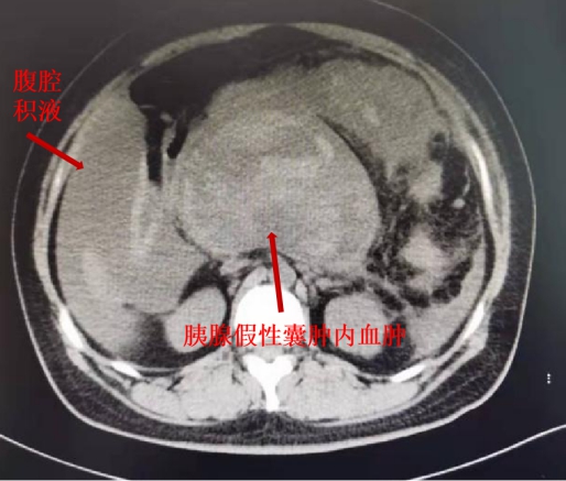 腹腔出血ct图片图片